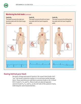 246
OBTAINING A 12-LEAD ECG
Seeing behind your back
Because of lung and muscle barriers, the usual chest leads can’t
“see” the heart’s posterior surface to record myocardial damage
there. Some practitioners add three posterior leads to the 12-lead
ECG: leads V7, V8, and V9. These leads are placed opposite
anterior leads V4, V5, and V6, on the left side of the patient’s back,
following the same horizontal line.
Monitoring the limb leads (continued)
Lead aVR
This lead connects the right arm
(positive pole) with the heart (nega-
tive pole).
Lead aVL
This lead connects the left arm (posi-
tive pole) with the heart (negative
pole).
Lead aVF
This lead connects the left leg (posi-
tive pole) with the heart (negative
pole).
RA (+)
+
–
aVR
LA (+)
+
–
L
–
aVL
+
–
LL (+)
aVF
–
LL (+)
ECG_Chap11.indd 246
ECG_Chap11.indd 246 7/8/2010 4:33:25 PM
7/8/2010 4:33:25 PM
 