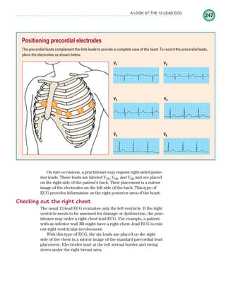 247
A LOOK AT THE 12-LEAD ECG
On rare occasions, a practitioner may request right-sided poste-
rior leads. These leads are labeled V7R, V8R, and V9R and are placed
on the right side of the patient’s back. Their placement is a mirror
image of the electrodes on the left side of the back. This type of
ECG provides information on the right posterior area of the heart.
Checking out the right chest
The usual 12-lead ECG evaluates only the left ventricle. If the right
ventricle needs to be assessed for damage or dysfunction, the prac-
titioner may order a right chest lead ECG. For example, a patient
with an inferior wall MI might have a right chest–lead ECG to rule
out right ventricular involvement.
With this type of ECG, the six leads are placed on the right
side of the chest in a mirror image of the standard precordial lead
placement. Electrodes start at the left sternal border and swing
down under the right breast area.
Positioning precordial electrodes
The precordial leads complement the limb leads to provide a complete view of the heart. To record the precordial leads,
place the electrodes as shown below.
V6
V5
V4
V3
V2
V1
V1
V3
V5 V6
V4
V2
ECG_Chap11.indd 247
ECG_Chap11.indd 247 7/8/2010 4:33:28 PM
7/8/2010 4:33:28 PM
 