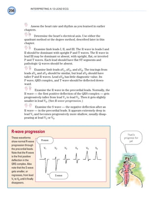 256
INTERPRETING A 12-LEAD ECG
Assess the heart rate and rhythm as you learned in earlier
chapters.
Determine the heart’s electrical axis. Use either the
quadrant method or the degree method, described later in this
chapter.
Examine limb leads I, II, and III. The R wave in leads I and
II should be dominant with upright P and T waves. The R wave in
lead III may be dominant or absent, with upright, flat, or inverted
P and T waves. Each lead should have flat ST segments and
pathologic Q waves should be absent.
Examine limb leads aVL, aVF, and aVR. The tracings from
leads aVL and aVF should be similar, but lead aVF should have
taller P and R waves. Lead aVR has little diagnostic value. Its
P wave, QRS complex, and T wave should be deflected down-
ward.
Examine the R wave in the precordial leads. Normally, the
R wave — the first positive deflection of the QRS complex — gets
progressively taller from lead V1 to lead V5. Then it gets slightly
smaller in lead V6. (See R-wave progression.)
Examine the S wave — the negative deflection after an
R wave — in the precordial leads. It appears extremely deep in
lead V1 and becomes progressively more shallow, usually disap-
pearing at lead V5 or V6.
That’s
progress for
ya!
R-wave progression
These waveforms
show normal R-wave
progression through
the precordial leads.
Note that the R wave
is the first positive
deflection in the
QRS complex. Also
note that the S wave
gets smaller, or
regresses, from lead
V1 to V6 until it finally
disappears.
V1 V2 V3 V4 V5 V6
R wave
S wave
ECG_Chap12.indd 256
ECG_Chap12.indd 256 7/8/2010 4:36:59 PM
7/8/2010 4:36:59 PM
 