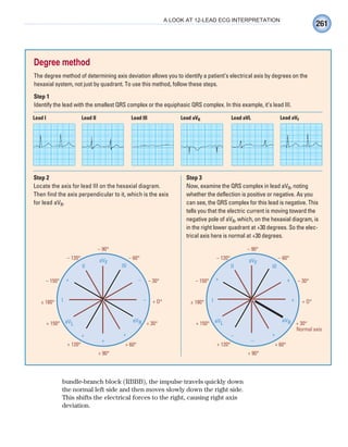 261
A LOOK AT 12-LEAD ECG INTERPRETATION
bundle-branch block (RBBB), the impulse travels quickly down
the normal left side and then moves slowly down the right side.
This shifts the electrical forces to the right, causing right axis
deviation.
Degree method
The degree method of determining axis deviation allows you to identify a patient’s electrical axis by degrees on the
hexaxial system, not just by quadrant. To use this method, follow these steps.
Step 1
Identify the lead with the smallest QRS complex or the equiphasic QRS complex. In this example, it’s lead III.
– 90°
– 60°
– 30°
+ 30°
+ 60°
+ 90°
+ 120°
+ 150°
– 150°
– 120°
± 180° + O°
aVF
aVL
aVR
III
–
–
+
+
II
+
+
I
– 90°
– 60°
– 30°
+ 30°
+ 60°
+ 90°
+ 120°
+ 150°
– 150°
– 120°
± 180° + O°
aVL
Normal axis
III
+
+
+
+
II
–
–
I
aVF
aVL aVR
Step 2
Locate the axis for lead III on the hexaxial diagram.
Then find the axis perpendicular to it, which is the axis
for lead aVR.
Step 3
Now, examine the QRS complex in lead aVR, noting
whether the deflection is positive or negative. As you
can see, the QRS complex for this lead is negative. This
tells you that the electric current is moving toward the
negative pole of aVR, which, on the hexaxial diagram, is
in the right lower quadrant at +30 degrees. So the elec-
trical axis here is normal at +30 degrees.
Lead I Lead II Lead III Lead aVR Lead aVL Lead aVF
ECG_Chap12.indd 261
ECG_Chap12.indd 261 7/8/2010 4:37:12 PM
7/8/2010 4:37:12 PM
 