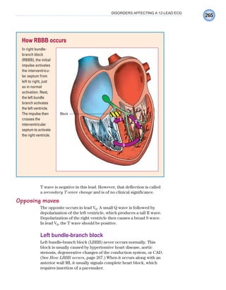 265
DISORDERS AFFECTING A 12-LEAD ECG
T wave is negative in this lead. However, that deflection is called
a secondary T-wave change and is of no clinical significance.
Opposing moves
The opposite occurs in lead V6. A small Q wave is followed by
depolarization of the left ventricle, which produces a tall R wave.
Depolarization of the right ventricle then causes a broad S wave.
In lead V6, the T wave should be positive.
Left bundle-branch block
Left bundle-branch block (LBBB) never occurs normally. This
block is usually caused by hypertensive heart disease, aortic
stenosis, degenerative changes of the conduction system, or CAD.
(See How LBBB occurs, page 267.) When it occurs along with an
anterior wall MI, it usually signals complete heart block, which
requires insertion of a pacemaker.
How RBBB occurs
In right bundle-
branch block
(RBBB), the initial
impulse activates
the interventricu-
lar septum from
left to right, just
as in normal
activation. Next,
the left bundle
branch activates
the left ventricle.
The impulse then
crosses the
interventricular
septum to activate
the right ventricle.
Block
1
2
3
ECG_Chap12.indd 265
ECG_Chap12.indd 265 7/8/2010 4:37:17 PM
7/8/2010 4:37:17 PM
 