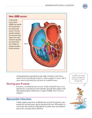 267
DISORDERS AFFECTING A 12-LEAD ECG
of depolarization spreads from the right ventricle to the left, a
wide S wave is produced in lead V1, with a positive T wave. The S
wave may be preceded by a Q wave or a small R wave.
Slurring your R waves
In lead V6, no initial Q wave occurs. A tall, notched R wave, or a
slurred one, is produced as the impulse spreads from right to left.
This initial positive deflection is a sign of LBBB. The T wave is
negative.
Myocardial infarction
Unlike angina, pain from an MI lasts for at least 20 minutes, may
persist for several hours, and is unrelieved by rest. MI usually oc-
curs in the left ventricle, although the location may vary depend-
ing on the coronary artery affected.
How LBBB occurs
In left bundle-
branch block
(LBBB), the impulse
first travels down
the right bundle
branch. Then the
impulse activates
the interventricular
septum from right
to left, the opposite
of normal activa-
tion. Finally, the
impulse activates
the left ventricle.
Block
1
2
3
In LBBB, the S wave
may be preceded by
a Q wave or R wave.
Cowabunga!
ECG_Chap12.indd 267
ECG_Chap12.indd 267 7/8/2010 4:37:23 PM
7/8/2010 4:37:23 PM
 