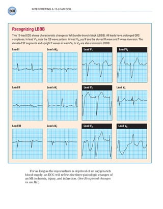 268
INTERPRETING A 12-LEAD ECG
For as long as the myocardium is deprived of an oxygen-rich
blood supply, an ECG will reflect the three pathologic changes of
an MI: ischemia, injury, and infarction. (See Reciprocal changes
in an MI.)
Recognizing LBBB
This 12-lead ECG shows characteristic changes of left bundle-branch block (LBBB). All leads have prolonged QRS
complexes. In lead V1, note the QS wave pattern. In lead V6, you’ll see the slurred R wave and T-wave inversion. The
elevated ST segments and upright T waves in leads V1 to V4 are also common in LBBB.
Lead III Lead aVF Lead V3 Lead V6
Lead II Lead aVL Lead V2 Lead V5
Lead I Lead aVR Lead V1 Lead V4
ECG_Chap12.indd 268
ECG_Chap12.indd 268 7/8/2010 4:37:27 PM
7/8/2010 4:37:27 PM
 
