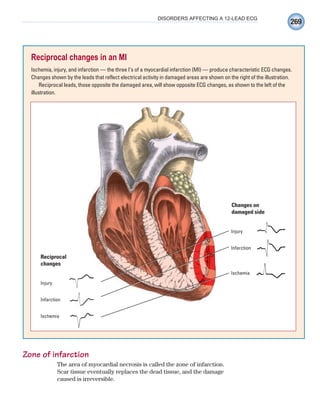 269
DISORDERS AFFECTING A 12-LEAD ECG
Zone of infarction
The area of myocardial necrosis is called the zone of infarction.
Scar tissue eventually replaces the dead tissue, and the damage
caused is irreversible.
Reciprocal changes in an MI
Ischemia, injury, and infarction — the three I’s of a myocardial infarction (MI) — produce characteristic ECG changes.
Changes shown by the leads that reflect electrical activity in damaged areas are shown on the right of the illustration.
Reciprocal leads, those opposite the damaged area, will show opposite ECG changes, as shown to the left of the
illustration.
Changes on
damaged side
Injury
Infarction
Ischemia
Reciprocal
changes
Injury
Infarction
Ischemia
ECG_Chap12.indd 269
ECG_Chap12.indd 269 7/8/2010 4:37:33 PM
7/8/2010 4:37:33 PM
 