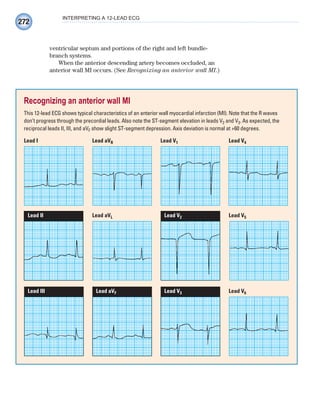 272
INTERPRETING A 12-LEAD ECG
ventricular septum and portions of the right and left bundle-
branch systems.
When the anterior descending artery becomes occluded, an
anterior wall MI occurs. (See Recognizing an anterior wall MI.)
Recognizing an anterior wall MI
This 12-lead ECG shows typical characteristics of an anterior wall myocardial infarction (MI). Note that the R waves
don’t progress through the precordial leads. Also note the ST-segment elevation in leads V2 and V3. As expected, the
reciprocal leads II, III, and aVF show slight ST-segment depression. Axis deviation is normal at +60 degrees.
Lead I Lead aVR Lead V1 Lead V4
Lead III Lead aVF Lead V3 Lead V6
Lead II Lead aVL Lead V2 Lead V5
ECG_Chap12.indd 272
ECG_Chap12.indd 272 7/8/2010 4:37:39 PM
7/8/2010 4:37:39 PM
 