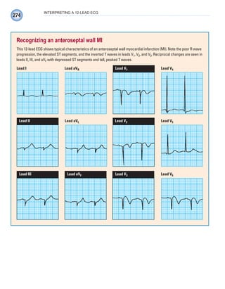 274
INTERPRETING A 12-LEAD ECG
Recognizing an anteroseptal wall MI
This 12-lead ECG shows typical characteristics of an anteroseptal wall myocardial infarction (MI). Note the poor R wave
progression, the elevated ST segments, and the inverted T waves in leads V1, V2, and V3. Reciprocal changes are seen in
leads II, III, and aVF with depressed ST segments and tall, peaked T waves.
Lead I Lead aVR Lead V1 Lead V4
Lead III Lead aVF Lead V3 Lead V6
Lead II Lead aVL Lead V2 Lead V5
ECG_Chap12.indd 274
ECG_Chap12.indd 274 7/8/2010 4:37:46 PM
7/8/2010 4:37:46 PM
 