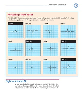 275
IDENTIFYING TYPES OF MI
Right ventricular MI
A right ventricular MI usually follows occlusion of the right coro-
nary artery. This type of MI rarely occurs alone. In fact, 40% of all
patients with an inferior wall MI also suffer a right ventricular MI.
Recognizing a lateral wall MI
This 12-lead ECG shows changes characteristic of a lateral wall myocardial infarction (MI). In leads I, aVL, V5, and V6,
note the pathologic Q waves, the ST-segment elevation, and the T-wave inversion.
Lead I Lead aVR Lead V1 Lead V4
Lead III Lead aVF Lead V3 Lead V6
Lead II Lead aVL Lead V2 Lead V5
ECG_Chap12.indd 275
ECG_Chap12.indd 275 7/8/2010 4:37:51 PM
7/8/2010 4:37:51 PM
 