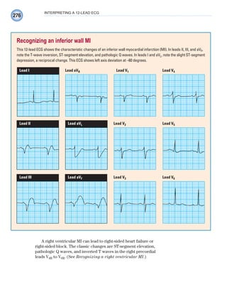 276
INTERPRETING A 12-LEAD ECG
A right ventricular MI can lead to right-sided heart failure or
right-sided block. The classic changes are ST-segment elevation,
pathologic Q waves, and inverted T waves in the right precordial
leads V4R to V6R. (See Recognizing a right ventricular MI.)
Recognizing an inferior wall MI
This 12-lead ECG shows the characteristic changes of an inferior wall myocardial infarction (MI). In leads II, III, and aVF,
note the T-wave inversion, ST-segment elevation, and pathologic Q waves. In leads I and aVL, note the slight ST-segment
depression, a reciprocal change. This ECG shows left axis deviation at –60 degrees.
Lead I Lead aVR Lead V1 Lead V4
Lead III Lead aVF Lead V3 Lead V6
Lead II Lead aVL Lead V2 Lead V5
ECG_Chap12.indd 276
ECG_Chap12.indd 276 7/8/2010 4:37:56 PM
7/8/2010 4:37:56 PM
 