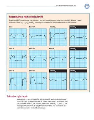 277
IDENTIFYING TYPES OF MI
Take the right lead
Identifying a right ventricular MI is difficult without information
from the right precordial leads. If these leads aren’t available, you
can observe leads II, III, and aVF or watch leads V1, V2, and V3 for
ST-segment elevation. If a right ventricular MI has occurred, use
lead II to monitor for further damage.
Recognizing a right ventricular MI
This 12-lead ECG shows typical characteristics of a right ventricular myocardial infarction (MI). Note the T-wave
inversion in leads V3R, V4R, V5R, and V6R. Pathologic Q waves and ST-segment elevation are also present.
Lead I Lead aVR Lead V1 Lead V4R
Lead III Lead aVF Lead V3R Lead V6R
Lead II Lead aVL Lead V2 Lead V5R
ECG_Chap12.indd 277
ECG_Chap12.indd 277 7/8/2010 4:37:59 PM
7/8/2010 4:37:59 PM
 