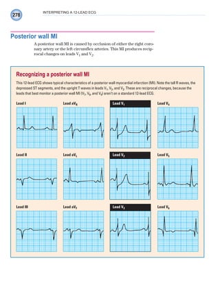 278
INTERPRETING A 12-LEAD ECG
Posterior wall MI
A posterior wall MI is caused by occlusion of either the right coro-
nary artery or the left circumflex arteries. This MI produces recip-
rocal changes on leads V1 and V2.
Recognizing a posterior wall MI
This 12-lead ECG shows typical characteristics of a posterior wall myocardial infarction (MI). Note the tall R waves, the
depressed ST segments, and the upright T waves in leads V1, V2, and V3. These are reciprocal changes, because the
leads that best monitor a posterior wall MI (V7, V8, and V9) aren’t on a standard 12-lead ECG.
Lead I Lead aVR Lead V1 Lead V4
Lead III Lead aVF Lead V3 Lead V6
Lead II Lead aVL Lead V2 Lead V5
ECG_Chap12.indd 278
ECG_Chap12.indd 278 7/8/2010 4:38:05 PM
7/8/2010 4:38:05 PM
 