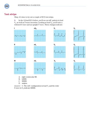 282
INTERPRETING A 12-LEAD ECG
Test strips
Okay, it’s time to try out a couple of ECG test strips.
8. In the 12-lead ECG below, you’ll see an rsR⬘ pattern in lead
V1, as well as T-wave inversion. Looking at lead V6, you’ll note a
widened S wave and an upright T wave. These changes indicate:
V2 V5
aVL
II
V3 V6
aVF
III
V1
aVR
I V4
A. right ventricular MI.
B. LBBB.
C. RBBB.
D. angina.
Answer: C. The rsR⬘ configuration in lead V1 and the wide
S wave in V6 indicate RBBB.
ECG_Chap12.indd 282
ECG_Chap12.indd 282 7/8/2010 4:38:11 PM
7/8/2010 4:38:11 PM
 