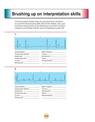 310
Brushing up on interpretation skills
Use these sample rhythm strips as a practical way to brush up
on your ECG interpretation skills. Record the rhythm, rates, and
waveform characteristics in the blank spaces provided, and then
compare your findings with the answers beginning on page 329.
1.
Atrial rhythm: ________________ QRS complex: ________________
Ventricular rhythm: ___________ T wave:______________________
Atrial rate: ___________________ QT interval: __________________
Ventricular rate: ______________ Other: _______________________
P wave:______________________ Interpretation:________________
PR interval: __________________ _____________________________
2.
Atrial rhythm:________________ QRS complex: _______________
Ventricular rhythm: ___________ T wave:______________________
Atrial rate: ___________________ QT interval: __________________
Ventricular rate: ______________ Other: _______________________
P wave:______________________ Interpretation:________________
PR interval: __________________ _____________________________
ECG_BM.indd 310
ECG_BM.indd 310 7/7/2010 5:46:18 PM
7/7/2010 5:46:18 PM
 