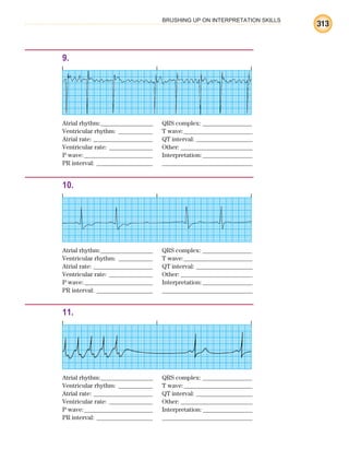 BRUSHING UP ON INTERPRETATION SKILLS
313
9.
Atrial rhythm:________________ QRS complex: _______________
Ventricular rhythm: ___________ T wave:______________________
Atrial rate: ___________________ QT interval: __________________
Ventricular rate: ______________ Other: _______________________
P wave:______________________ Interpretation:________________
PR interval: __________________ _____________________________
10.
Atrial rhythm:________________ QRS complex: _______________
Ventricular rhythm: ___________ T wave:______________________
Atrial rate: ___________________ QT interval: __________________
Ventricular rate: ______________ Other: _______________________
P wave:______________________ Interpretation:________________
PR interval: __________________ _____________________________
11.
Atrial rhythm:________________ QRS complex: _______________
Ventricular rhythm: ___________ T wave:______________________
Atrial rate: ___________________ QT interval: __________________
Ventricular rate: ______________ Other: _______________________
P wave:______________________ Interpretation:________________
PR interval: __________________ _____________________________
ECG_BM.indd 313
ECG_BM.indd 313 7/7/2010 5:46:19 PM
7/7/2010 5:46:19 PM
 