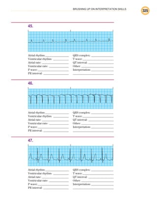 BRUSHING UP ON INTERPRETATION SKILLS
325
45.
Atrial rhythm:________________ QRS complex: _______________
Ventricular rhythm: ___________ T wave:______________________
Atrial rate: ___________________ QT interval: __________________
Ventricular rate: ______________ Other: _______________________
P wave:______________________ Interpretation:________________
PR interval: __________________ _____________________________
46.
Atrial rhythm:________________ QRS complex: _______________
Ventricular rhythm: ___________ T wave:______________________
Atrial rate: ___________________ QT interval: __________________
Ventricular rate: ______________ Other: _______________________
P wave:______________________ Interpretation:________________
PR interval: __________________ _____________________________
47.
Atrial rhythm:________________ QRS complex: _______________
Ventricular rhythm: ___________ T wave:______________________
Atrial rate: ___________________ QT interval: __________________
Ventricular rate: ______________ Other: _______________________
P wave:______________________ Interpretation:________________
PR interval: __________________ _____________________________
ECG_BM.indd 325
ECG_BM.indd 325 7/7/2010 5:46:28 PM
7/7/2010 5:46:28 PM
 