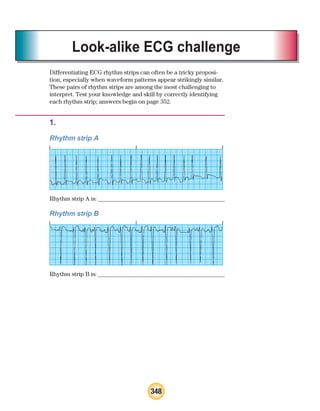 348
Look-alike ECG challenge
Differentiating ECG rhythm strips can often be a tricky proposi-
tion, especially when waveform patterns appear strikingly similar.
These pairs of rhythm strips are among the most challenging to
interpret. Test your knowledge and skill by correctly identifying
each rhythm strip; answers begin on page 352.
1.
Rhythm strip A
Rhythm strip A is:
1.Rhythm strip B
Rhythm strip B is:
ECG_BM.indd 348
ECG_BM.indd 348 7/7/2010 5:46:32 PM
7/7/2010 5:46:32 PM
 