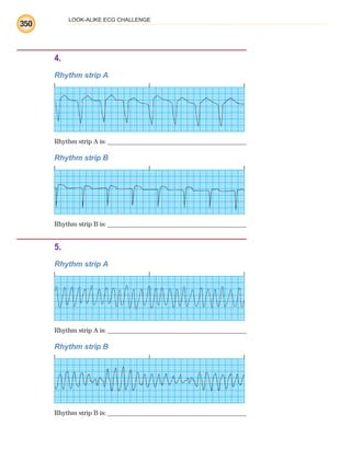 LOOK-ALIKE ECG CHALLENGE
350
4.
Rhythm strip A
Rhythm strip A is:
1.Rhythm strip B
Rhythm strip B is:
5.
Rhythm strip A
Rhythm strip A is:
1.Rhythm strip B
Rhythm strip B is:
ECG_BM.indd 350
ECG_BM.indd 350 7/7/2010 5:46:34 PM
7/7/2010 5:46:34 PM
 