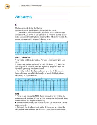 LOOK-ALIKE ECG CHALLENGE
352
Answers
1.
Rhythm strip A: Atrial fibrillation
Rhythm strip B: Multifocal atrial tachycardia (MAT)
To help you decide whether a rhythm is atrial fibrillation or
the similar MAT, focus on the presence of P waves as well as the
atrial and ventricular rhythms. You may find it helpful to look at a
longer (greater than 6 seconds) rhythm strip.
Atrial fibrillation
Carefully look for discernible P waves before each QRS com-
•
plex.
If you can’t clearly identify P waves, fibrillatory (f) waves ap-
•
pear in place of P waves, and the rhythm is irregular, then the
rhythm is probably atrial fibrillation.
Carefully look at the rhythm, focusing on the R-R intervals.
•
Remember that one of the hallmarks of atrial fibrillation is an
irregularly irregular rhythm.
MAT
P waves are present in MAT. Keep in mind, however, that the
•
shape of the P waves will vary, with at least three different P wave
shapes visible in a single rhythm strip.
You should be able to see most, if not all, of the various P wave
•
shapes repeat.
Although the atrial and ventricular rhythms are irregular, the
•
irregularity generally isn’t as pronounced as in atrial fibrillation.
ECG_BM.indd 352
ECG_BM.indd 352 7/7/2010 5:46:36 PM
7/7/2010 5:46:36 PM
 