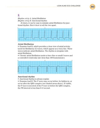 LOOK-ALIKE ECG CHALLENGE
353
2.
Rhythm strip A: Atrial fibrillation
Rhythm strip B: Junctional rhythm
At times, it can be easy to mistake atrial fibrillation for junc-
tional rhythm. Here’s how to tell the two apart.
Atrial fibrillation
Examine lead II, which provides a clear view of atrial activity.
•
Look for fibrillatory (f) waves, which appear as a wavy line. These
waves indicate atrial fibrillation. The rhythm is irregular with
atrial fibrillation.
Chronic atrial fibrillation tends to have fine or small f waves and
•
a controlled ventricular rate (less than 100 beats/minute).
Junctional rhythm
Junctional rhythm is always regular.
•
Examine lead II. The P wave may occur before, be hidden in, or
•
occur after the QRS complex (see shaded areas above). If visible,
the P wave is inverted; if the P wave is before the QRS complex,
the PR interval is less than 0.12 second.
ECG_BM.indd 353
ECG_BM.indd 353 7/7/2010 5:46:36 PM
7/7/2010 5:46:36 PM
 