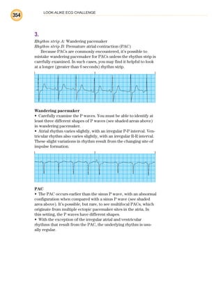 LOOK-ALIKE ECG CHALLENGE
354
3.
Rhythm strip A: Wandering pacemaker
Rhythm strip B: Premature atrial contraction (PAC)
Because PACs are commonly encountered, it’s possible to
mistake wandering pacemaker for PACs unless the rhythm strip is
carefully examined. In such cases, you may find it helpful to look
at a longer (greater than 6 seconds) rhythm strip.
Wandering pacemaker
Carefully examine the P waves. You must be able to identify at
•
least three different shapes of P waves (see shaded areas above)
in wandering pacemaker.
Atrial rhythm varies slightly, with an irregular P-P interval. Ven-
•
tricular rhythm also varies slightly, with an irregular R-R interval.
These slight variations in rhythm result from the changing site of
impulse formation.
PAC
The PAC occurs earlier than the sinus P wave, with an abnormal
•
configuration when compared with a sinus P wave (see shaded
area above). It’s possible, but rare, to see multifocal PACs, which
originate from multiple ectopic pacemaker sites in the atria. In
this setting, the P waves have different shapes.
With the exception of the irregular atrial and ventricular
•
rhythms that result from the PAC, the underlying rhythm is usu-
ally regular.
ECG_BM.indd 354
ECG_BM.indd 354 7/7/2010 5:46:36 PM
7/7/2010 5:46:36 PM
 