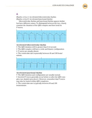 LOOK-ALIKE ECG CHALLENGE
355
4.
Rhythm strip A: Accelerated idioventricular rhythm
Rhythm strip B: Accelerated junctional rhythm
Idioventricular rhythm and junctional rhythm appear similar
but have different causes. To distinguish between the two, closely
examine the duration of the QRS complex and then look for
P waves.
Accelerated idioventricular rhythm
The QRS duration will be greater than 0.12 second.
•
The QRS complex will have a wide and bizarre configuration.
•
P waves are usually absent.
•
The ventricular rate is generally between 40 and 100 beats/
•
minute.
Accelerated junctional rhythm
The QRS duration and configuration are usually normal.
•
Inverted P waves generally occur before or after the QRS com-
•
plex (see shaded area above). However, remember that P waves
may also be buried within QRS complexes.
The ventricular rate is typically between 60 and 100
•
beats/minute.
ECG_BM.indd 355
ECG_BM.indd 355 7/7/2010 5:46:37 PM
7/7/2010 5:46:37 PM
 