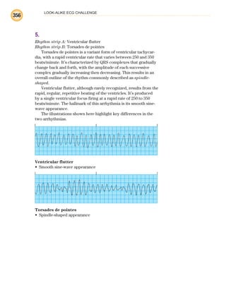 LOOK-ALIKE ECG CHALLENGE
356
5.
Rhythm strip A: Ventricular flutter
Rhythm strip B: Torsades de pointes
Torsades de pointes is a variant form of ventricular tachycar-
dia, with a rapid ventricular rate that varies between 250 and 350
beats/minute. It’s characterized by QRS complexes that gradually
change back and forth, with the amplitude of each successive
complex gradually increasing then decreasing. This results in an
overall outline of the rhythm commonly described as spindle-
shaped.
Ventricular flutter, although rarely recognized, results from the
rapid, regular, repetitive beating of the ventricles. It’s produced
by a single ventricular focus firing at a rapid rate of 250 to 350
beats/minute. The hallmark of this arrhythmia is its smooth sine-
wave appearance.
The illustrations shown here highlight key differences in the
two arrhythmias.
Ventricular flutter
Smooth sine-wave appearance
•
Torsades de pointes
Spindle-shaped appearance
•
ECG_BM.indd 356
ECG_BM.indd 356 7/7/2010 5:46:37 PM
7/7/2010 5:46:37 PM
 