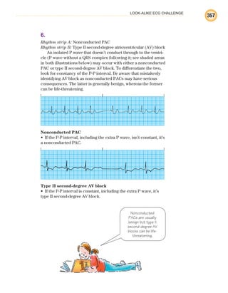 LOOK-ALIKE ECG CHALLENGE
357
6.
Rhythm strip A: Nonconducted PAC
Rhythm strip B: Type II second-degree atrioventricular (AV) block
An isolated P wave that doesn’t conduct through to the ventri-
cle (P wave without a QRS complex following it; see shaded areas
in both illustrations below) may occur with either a nonconducted
PAC or type II second-degree AV block. To differentiate the two,
look for constancy of the P-P interval. Be aware that mistakenly
identifying AV block as nonconducted PACs may have serious
consequences. The latter is generally benign, whereas the former
can be life-threatening.
Nonconducted PAC
If the P-P interval, including the extra P wave, isn’t constant, it’s
•
a nonconducted PAC.
Type II second-degree AV block
If the P-P interval is constant, including the extra P wave, it’s
•
type II second-degree AV block.
Nonconducted
PACs are usually
benign but type II
second-degree AV
blocks can be life-
threatening.
ECG_BM.indd 357
ECG_BM.indd 357 7/7/2010 5:46:38 PM
7/7/2010 5:46:38 PM
 