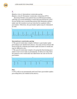 LOOK-ALIKE ECG CHALLENGE
358
7.
Rhythm strip A: Intermittent ventricular pacing
Rhythm strip B: Premature ventricular contraction (PVC)
Knowing whether your patient has an artificial pacemaker
will help you avoid mistaking a ventricular paced beat for a PVC.
If your facility uses a monitoring system that eliminates artifact,
make sure the monitor is set up correctly for a patient with a
pacemaker. Otherwise, the pacemaker spikes may be eliminated
as well.
Intermittent ventricular pacing
The paced ventricular complex will have a pacemaker spike
•
preceding it (see shaded area above). You may need to look in dif-
ferent leads for a bipolar pacemaker spike because it’s small and
may be difficult to see.
The paced ventricular complex of a properly functioning pace-
•
maker won’t occur early or prematurely. It will occur only when
the patient’s own ventricular rate falls below the rate set for the
pacemaker.
PVC
PVCs will occur prematurely and won’t have pacemaker spikes
•
preceding them (see shaded areas above).
ECG_BM.indd 358
ECG_BM.indd 358 7/7/2010 5:46:39 PM
7/7/2010 5:46:39 PM
 