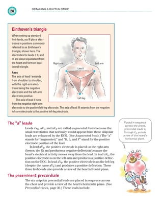 28
OBTAINING A RHYTHM STRIP
The “a” leads
Leads aVR, aVL, and aVF are called augmented leads because the
small waveforms that normally would appear from these unipolar
leads are enhanced by the ECG. (See Augmented leads.) The “a”
stands for “augmented,” and “R, L, and F” stand for the positive
electrode position of the lead.
In lead aVR, the positive electrode is placed on the right arm
(hence, the R) and produces a negative deflection because the
heart’s electrical activity moves away from the lead. In lead aVL, the
positive electrode is on the left arm and produces a positive deflec-
tion on the ECG. In lead aVF, the positive electrode is on the left leg
(despite the name aVF) and produces a positive deflection. These
three limb leads also provide a view of the heart’s frontal plane.
The preeminent precordials
The six unipolar precordial leads are placed in sequence across
the chest and provide a view of the heart’s horizontal plane. (See
Precordial views, page 30.) These leads include:
Einthoven’s triangle
When setting up standard
limb leads, you’ll place elec-
trodes in positions commonly
referred to as Einthoven’s
triangle, shown here. The
electrodes for leads I, II, and
III are about equidistant from
the heart and form an equi-
lateral triangle.
Axes
The axis of lead I extends
from shoulder to shoulder,
with the right-arm elec-
trode being the negative
electrode and the left-arm
electrode positive.
The axis of lead II runs
from the negative right-arm
electrode to the positive left-leg electrode. The axis of lead III extends from the negative
left-arm electrode to the positive left-leg electrode.
Lead I
Right arm Left arm
Left leg
L
e
a
d
I
I
I
L
e
a
d
I
I
⫹
⫺
⫺ ⫺
⫹ ⫹
Placed in sequence
across the chest,
precordial leads V1
through V6 provide
a view of the heart’s
horizontal plane.
ECG_Chap02.indd 28
ECG_Chap02.indd 28 7/8/2010 4:16:45 PM
7/8/2010 4:16:45 PM
 