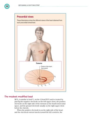 30
OBTAINING A RHYTHM STRIP
The modest modified lead
MCL1 is similar to lead V1 on the 12-lead ECG and is created by
placing the negative electrode on the left upper chest, the positive
electrode on the right side of the sternum at the fourth intercostal
space, and the ground electrode usually on the right upper chest
below the clavicle.
When the positive electrode is on the right side of the heart
and the electrical current travels toward the left ventricle, the
Precordial views
These illustrations show the different views of the heart obtained from
each precordial (chest) lead.
V1 V2
V3
V4
V5
V6
Center of the heart
(zero point)
Posterior
ECG_Chap02.indd 30
ECG_Chap02.indd 30 7/8/2010 4:16:50 PM
7/8/2010 4:16:50 PM
 