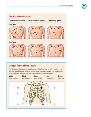 33
ALL ABOUT LEADS
Leadwire systems (continued)
Five-leadwire system Three-leadwire system Telemetry system
RA LA
LL
RL
C
RA LA
LL
G
–
+
G
–
+
RA LA
LL
RA LA
LL
RL
C
Lead MCL1
Lead MCL6
Using a five-leadwire system
This illustration shows the correct placement of the leadwires for a five-leadwire sys-
tem. The chest electrode shown is located in the V1 position, but you can place it in any
of the chest-lead positions. The electrodes are color-coded as follows.
White:
right arm (RA)
Black:
left arm (LA)
Green:
right leg (RL)
Red:
left leg (LL)
Brown:
chest (C)
RA
C
RL
LA
LL
ECG_Chap02.indd 33
ECG_Chap02.indd 33 7/8/2010 4:16:55 PM
7/8/2010 4:16:55 PM
 