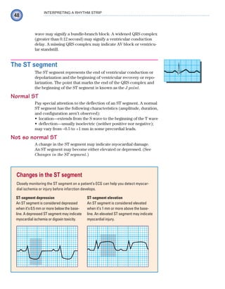 48
INTERPRETING A RHYTHM STRIP
wave may signify a bundle-branch block. A widened QRS complex
(greater than 0.12 second) may signify a ventricular conduction
delay. A missing QRS complex may indicate AV block or ventricu-
lar standstill.
The ST segment
The ST segment represents the end of ventricular conduction or
depolarization and the beginning of ventricular recovery or repo-
larization. The point that marks the end of the QRS complex and
the beginning of the ST segment is known as the J point.
Normal ST
Pay special attention to the deflection of an ST segment. A normal
ST segment has the following characteristics (amplitude, duration,
and configuration aren’t observed):
location—extends from the S wave to the beginning of the T wave
•
deflection—usually isoelectric (neither positive nor negative);
•
may vary from –0.5 to +1 mm in some precordial leads.
Not so normal ST
A change in the ST segment may indicate myocardial damage.
An ST segment may become either elevated or depressed. (See
Changes in the ST segment.)
Changes in the ST segment
Closely monitoring the ST segment on a patient’s ECG can help you detect myocar-
dial ischemia or injury before infarction develops.
ST-segment depression
An ST segment is considered depressed
when it’s 0.5 mm or more below the base-
line. A depressed ST segment may indicate
myocardial ischemia or digoxin toxicity.
ST-segment elevation
An ST segment is considered elevated
when it’s 1 mm or more above the base-
line. An elevated ST segment may indicate
myocardial injury.
ECG_Chap03.indd 48
ECG_Chap03.indd 48 7/7/2010 5:51:01 PM
7/7/2010 5:51:01 PM
 