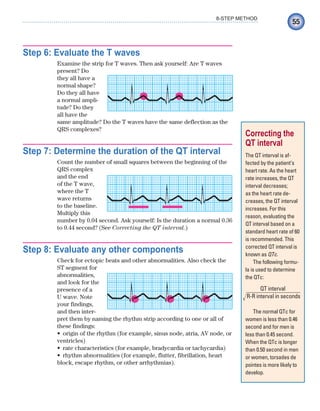 55
8-STEP METHOD
Step 6: Evaluate the T waves
Examine the strip for T waves. Then ask yourself: Are T waves
present? Do
they all have a
normal shape?
Do they all have
a normal ampli-
tude? Do they
all have the
same amplitude? Do the T waves have the same deflection as the
QRS complexes?
Step 7: Determine the duration of the QT interval
Count the number of small squares between the beginning of the
QRS complex
and the end
of the T wave,
where the T
wave returns
to the baseline.
Multiply this
number by 0.04 second. Ask yourself: Is the duration a normal 0.36
to 0.44 second? (See Correcting the QT interval.)
Step 8: Evaluate any other components
Check for ectopic beats and other abnormalities. Also check the
ST segment for
abnormalities,
and look for the
presence of a
U wave. Note
your findings,
and then inter-
pret them by naming the rhythm strip according to one or all of
these findings:
origin of the rhythm (for example, sinus node, atria, AV node, or
•
ventricles)
rate characteristics (for example, bradycardia or tachycardia)
•
rhythm abnormalities (for example, flutter, fibrillation, heart
•
block, escape rhythm, or other arrhythmias).
Correcting the
QT interval
The QT interval is af-
fected by the patient’s
heart rate. As the heart
rate increases, the QT
interval decreases;
as the heart rate de-
creases, the QT interval
increases. For this
reason, evaluating the
QT interval based on a
standard heart rate of 60
is recommended. This
corrected QT interval is
known as QTc.
The following formu-
la is used to determine
the QTc:
QT interval
R-R interval in seconds
The normal QTc for
women is less than 0.46
second and for men is
less than 0.45 second.
When the QTc is longer
than 0.50 second in men
or women, torsades de
pointes is more likely to
develop.
⻫
ECG_Chap03.indd 55
ECG_Chap03.indd 55 7/7/2010 5:51:05 PM
7/7/2010 5:51:05 PM
 
