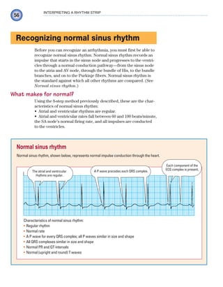 56
INTERPRETING A RHYTHM STRIP
Recognizing normal sinus rhythm
Before you can recognize an arrhythmia, you must first be able to
recognize normal sinus rhythm. Normal sinus rhythm records an
impulse that starts in the sinus node and progresses to the ventri-
cles through a normal conduction pathway—from the sinus node
to the atria and AV node, through the bundle of His, to the bundle
branches, and on to the Purkinje fibers. Normal sinus rhythm is
the standard against which all other rhythms are compared. (See
Normal sinus rhythm.)
What makes for normal?
Using the 8-step method previously described, these are the char-
acteristics of normal sinus rhythm:
Atrial and ventricular rhythms are regular.
•
Atrial and ventricular rates fall between 60 and 100 beats/minute,
•
the SA node’s normal firing rate, and all impulses are conducted
to the ventricles.
Normal sinus rhythm
Normal sinus rhythm, shown below, represents normal impulse conduction through the heart.
Characteristics of normal sinus rhythm:
Regular rhythm
•
Normal rate
•
A P wave for every QRS complex; all P waves similar in size and shape
•
All QRS complexes similar in size and shape
•
Normal PR and QT intervals
•
Normal (upright and round) T waves
•
A P wave precedes each QRS complex.
The atrial and ventricular
rhythms are regular.
Each component of the
ECG complex is present.
ECG_Chap03.indd 56
ECG_Chap03.indd 56 7/7/2010 5:51:06 PM
7/7/2010 5:51:06 PM
 