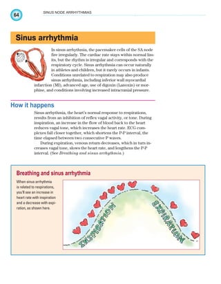 64
SINUS NODE ARRHYTHMIAS
Sinus arrhythmia
In sinus arrhythmia, the pacemaker cells of the SA node
fire irregularly. The cardiac rate stays within normal lim-
its, but the rhythm is irregular and corresponds with the
respiratory cycle. Sinus arrhythmia can occur naturally
in athletes and children, but it rarely occurs in infants.
Conditions unrelated to respiration may also produce
sinus arrhythmia, including inferior wall myocardial
infarction (MI), advanced age, use of digoxin (Lanoxin) or mor-
phine, and conditions involving increased intracranial pressure.
How it happens
Sinus arrhythmia, the heart’s normal response to respirations,
results from an inhibition of reflex vagal activity, or tone. During
inspiration, an increase in the flow of blood back to the heart
reduces vagal tone, which increases the heart rate. ECG com-
plexes fall closer together, which shortens the P-P interval, the
time elapsed between two consecutive P waves.
During expiration, venous return decreases, which in turn in-
creases vagal tone, slows the heart rate, and lengthens the P-P
interval. (See Breathing and sinus arrhythmia.)
Breathing and sinus arrhythmia
When sinus arrhythmia
is related to respirations,
you’ll see an increase in
heart rate with inspiration
and a decrease with expi-
ration, as shown here.
ECG_Chap04.indd 64
ECG_Chap04.indd 64 7/8/2010 9:30:06 AM
7/8/2010 9:30:06 AM
 