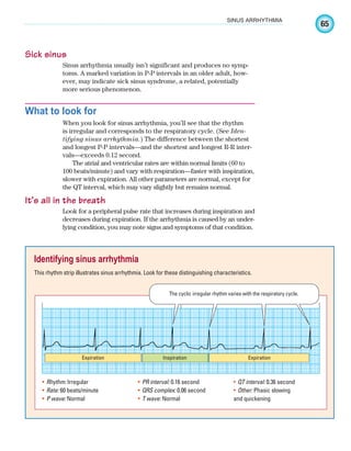 65
SINUS ARRHYTHMIA
Sick sinus
Sinus arrhythmia usually isn’t significant and produces no symp-
toms. A marked variation in P-P intervals in an older adult, how-
ever, may indicate sick sinus syndrome, a related, potentially
more serious phenomenon.
What to look for
When you look for sinus arrhythmia, you’ll see that the rhythm
is irregular and corresponds to the respiratory cycle. (See Iden-
tifying sinus arrhythmia.) The difference between the shortest
and longest P-P intervals—and the shortest and longest R-R inter-
vals—exceeds 0.12 second.
The atrial and ventricular rates are within normal limits (60 to
100 beats/minute) and vary with respiration—faster with inspiration,
slower with expiration. All other parameters are normal, except for
the QT interval, which may vary slightly but remains normal.
It’s all in the breath
Look for a peripheral pulse rate that increases during inspiration and
decreases during expiration. If the arrhythmia is caused by an under-
lying condition, you may note signs and symptoms of that condition.
Identifying sinus arrhythmia
This rhythm strip illustrates sinus arrhythmia. Look for these distinguishing characteristics.
Expiration Inspiration Expiration
The cyclic irregular rhythm varies with the respiratory cycle.
Rhythm:
• Irregular
Rate:
• 60 beats/minute
P wave:
• Normal
PR interval:
• 0.16 second
QRS complex:
• 0.06 second
T wave:
• Normal
QT interval:
• 0.36 second
Other:
• Phasic slowing
and quickening
ECG_Chap04.indd 65
ECG_Chap04.indd 65 7/8/2010 9:30:07 AM
7/8/2010 9:30:07 AM
 