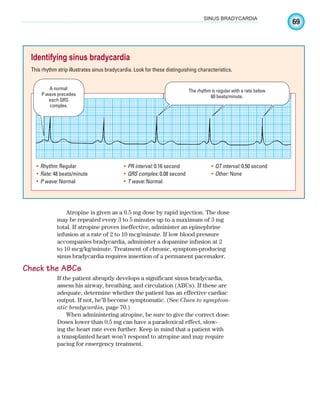 69
SINUS BRADYCARDIA
Atropine is given as a 0.5 mg dose by rapid injection. The dose
may be repeated every 3 to 5 minutes up to a maximum of 3 mg
total. If atropine proves ineffective, administer an epinephrine
infusion at a rate of 2 to 10 mcg/minute. If low blood pressure
accompanies bradycardia, administer a dopamine infusion at 2
to 10 mcg/kg/minute. Treatment of chronic, symptom-producing
sinus bradycardia requires insertion of a permanent pacemaker.
Check the ABCs
If the patient abruptly develops a significant sinus bradycardia,
assess his airway, breathing, and circulation (ABCs). If these are
adequate, determine whether the patient has an effective cardiac
output. If not, he’ll become symptomatic. (See Clues to symptom-
atic bradycardia, page 70.)
When administering atropine, be sure to give the correct dose:
Doses lower than 0.5 mg can have a paradoxical effect, slow-
ing the heart rate even further. Keep in mind that a patient with
a transplanted heart won’t respond to atropine and may require
pacing for emergency treatment.
Identifying sinus bradycardia
This rhythm strip illustrates sinus bradycardia. Look for these distinguishing characteristics.
Rhythm:
• Regular
Rate:
• 48 beats/minute
P wave:
• Normal
PR interval:
• 0.16 second
QRS complex:
• 0.08 second
T wave:
• Normal
QT interval:
• 0.50 second
Other:
• None
A normal
P wave precedes
each QRS
complex.
The rhythm is regular with a rate below
60 beats/minute.
ECG_Chap04.indd 69
ECG_Chap04.indd 69 7/8/2010 9:30:10 AM
7/8/2010 9:30:10 AM
 