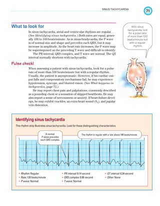 71
SINUS TACHYCARDIA
What to look for
In sinus tachycardia, atrial and ventricular rhythms are regular.
(See Identifying sinus tachycardia.) Both rates are equal, gener-
ally 100 to 160 beats/minute. As in sinus bradycardia, the P wave
is of normal size and shape and precedes each QRS, but it may
increase in amplitude. As the heart rate increases, the P wave may
be superimposed on the preceding T wave and difficult to identify.
The PR interval, QRS complex, and T wave are normal. The QT
interval normally shortens with tachycardia.
Pulse check!
When assessing a patient with sinus tachycardia, look for a pulse
rate of more than 100 beats/minute but with a regular rhythm.
Usually, the patient is asymptomatic. However, if his cardiac out-
put falls and compensatory mechanisms fail, he may experience
hypotension, syncope, and blurred vision. (See What happens in
tachycardia, page 72.)
He may report chest pain and palpitations, commonly described
as a pounding chest or a sensation of skipped heartbeats. He may
also report a sense of nervousness or anxiety. If heart failure devel-
ops, he may exhibit crackles, an extra heart sound (S3), and jugular
vein distention.
With sinus
tachycardia, look
for a pulse rate
of more than 100
beats/minute but
with a regular
rhythm.
Identifying sinus tachycardia
This rhythm strip illustrates sinus tachycardia. Look for these distinguishing characteristics.
A normal
P wave precedes
each QRS complex.
The rhythm is regular with a rate above 100 beats/minute.
Rhythm:
• Regular
Rate:
• 120 beats/minute
P wave:
• Normal
PR interval:
• 0.14 second
QRS complex:
• 0.06 second
T wave:
• Normal
QT interval:
• 0.34 second
Other:
• None
ECG_Chap04.indd 71
ECG_Chap04.indd 71 7/8/2010 9:30:11 AM
7/8/2010 9:30:11 AM
 