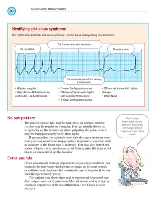 80
SINUS NODE ARRHYTHMIAS
No set pattern
The patient’s pulse rate may be fast, slow, or normal, and the
rhythm may be regular or irregular. You can usually detect an
irregularity on the monitor or when palpating the pulse, which
may feel inappropriately slow, then rapid.
If you monitor the patient’s heart rate during exercise or exer-
tion, you may observe an inappropriate response to exercise such
as a failure of the heart rate to increase. You may also detect epi-
sodes of brady-tachy syndrome, atrial flutter, atrial fibrillation, SA
block, or sinus arrest on the monitor.
Extra sounds
Other assessment findings depend on the patient’s condition. For
example, he may have crackles in the lungs, an S3 heart sound,
or a dilated and displaced left ventricular apical impulse if he has
underlying cardiomyopathy.
The patient may show signs and symptoms of decreased car-
diac output, such as hypotension, blurred vision, and syncope, a
common experience with this arrhythmia. (See Check mental
status.)
Identifying sick sinus syndrome
This rhythm strip illustrates sick sinus syndrome. Look for these distinguishing characteristics.
The sinus node doesn’t fire, causing
a sinus pause.
The rate is fast. The rate is slow.
The P wave varies with the rhythm.
Rhythm:
• Irregular
Rate:
• Atrial—60 beats/minute;
ventricular—70 beats/minute
P wave:
• Configuration varies
PR interval:
• Varies with rhythm
QRS complex:
• 0.10 second
T wave:
• Configuration varies
QT interval:
• Varies with rhythm
changes
Other:
• None
Monitoring
heart rate during
exercise may show
an inappropriate
response. Can I stop
now?!
ECG_Chap04.indd 80
ECG_Chap04.indd 80 7/8/2010 9:30:17 AM
7/8/2010 9:30:17 AM
 