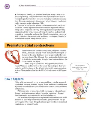 88
ATRIAL ARRHYTHMIAS
Reentry
• —In reentry, an impulse is delayed along a slow con-
duction pathway. Despite the delay, the impulse remains active
enough to produce another impulse during myocardial repolariza-
tion. Reentry may occur with coronary artery disease, cardiomyo-
pathy, or myocardial infarction (MI).
Triggered activity
• —An injured cell sometimes only partly re-
polarizes. Partial repolarization can lead to a repetitive ectopic
firing called triggered activity. The depolarization produced by
triggered activity is known as afterdepolarization and can lead
to atrial or ventricular tachycardia. Afterdepolarization can occur
with cell injury, digoxin toxicity, and other conditions. Now let’s
examine each atrial arrhythmia in detail.
Premature atrial contractions
Premature atrial contractions (PACs) originate outside
the SA node and usually result from an irritable spot, or
focus, in the atria that takes over as pacemaker for one
or more beats. The SA node fires an impulse, but then an
irritable focus jumps in, firing its own impulse before the
SA node can fire again.
PACs may be conducted through the atrioventri-
cular (AV) node and the rest of the heart, depending on their pre-
maturity and the status of the AV and intraventricular conduction
system. Nonconducted or blocked PACs don’t trigger a QRS com-
plex.
How it happens
PACs, which commonly occur in a normal heart, can be triggered
by alcohol, nicotine, anxiety, fatigue, fever, and infectious diseases.
A patient who eliminates or controls those factors can correct the
arrhythmias.
PACs may also be associated with coronary or valvular heart
disease, acute respiratory failure, hypoxia, pulmonary disease,
digoxin toxicity, and certain electrolyte imbalances.
PACs are rarely dangerous in a patient who doesn’t have heart
disease. In fact, they commonly cause no symptoms and can go
unrecognized for years. The patient may perceive PACs as normal
palpitations or skipped beats.
The nicotine in
cigarattes can cause
PACs. Yuk!
ECG_Chap05.indd 88
ECG_Chap05.indd 88 7/8/2010 12:32:28 PM
7/8/2010 12:32:28 PM
 