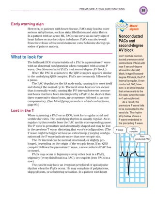 89
PREMATURE ATRIAL CONTRACTIONS
Early warning sign
However, in patients with heart disease, PACs may lead to more
serious arrhythmias, such as atrial fibrillation and atrial flutter.
In a patient with an acute MI, PACs can serve as an early sign of
heart failure or an electrolyte imbalance. PACs can also result
from the release of the neurohormone catecholamine during epi-
sodes of pain or anxiety.
What to look for
The hallmark ECG characteristic of a PAC is a premature P wave
with an abnormal configuration when compared with a sinus P
wave. (See Nonconducted PACs and second-degree AV block.)
When the PAC is conducted, the QRS complex appears similar
to the underlying QRS complex. PACs are commonly followed by
a pause.
The PAC depolarizes the SA node early, causing it to reset itself
and disrupt the normal cycle. The next sinus beat occurs sooner
than it normally would, causing the P-P interval between two nor-
mal beats that have been interrupted by a PAC to be shorter than
three consecutive sinus beats, an occurrence referred to as non-
compensatory. (See Identifying premature atrial contractions,
page 90.)
Lost in the T
When examining a PAC on an ECG, look for irregular atrial and
ventricular rates. The underlying rhythm is usually regular. An ir-
regular rhythm results from the PAC and its corresponding pause.
The P wave is premature and abnormally shaped and may be lost
in the previous T wave, distorting that wave’s configuration. (The
T wave might be bigger or have an extra bump.) Varying configu-
rations of the P wave indicate more than one ectopic site.
The PR interval can be normal, shortened, or slightly pro-
longed, depending on the origin of the ectopic focus. If no QRS
complex follows the premature P wave, a nonconducted PAC has
occurred.
PACs may occur in bigeminy (every other beat is a PAC),
trigeminy (every third beat is a PAC), or couplets (two PACs in a
row).
The patient may have an irregular peripheral or apical pulse
rhythm when the PACs occur. He may complain of palpitations,
skipped beats, or a fluttering sensation. In a patient with heart
Nonconducted
PACs and
second-degree
AV block
Don’t confuse noncon-
ducted premature atrial
contractions (PACs) with
type II second-degree
atrioventricular (AV)
block. In type II second-
degree AV block, the P-P
interval is regular. A non-
conducted PAC, how-
ever, is an atrial impulse
that arrives early to the
AV node, when the node
isn’t yet repolarized.
As a result, the
premature P wave fails
to be conducted to the
ventricle. The rhythm
strip below shows a
P wave embedded in
the preceding T wave.
Mixed
signals
Non-
conducted PAC
P wave QRS
complex
ECG_Chap05.indd 89
ECG_Chap05.indd 89 7/8/2010 12:32:29 PM
7/8/2010 12:32:29 PM
 