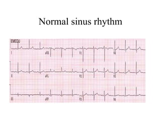 Normal sinus rhythm
 