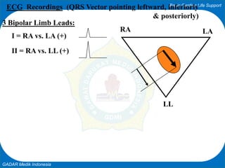 Basic Cardiac Life Support
GADAR Medik Indonesia
LARA
LL
ECG Recordings (QRS Vector pointing leftward, inferiorly
& posteriorly)
3 Bipolar Limb Leads:
I = RA vs. LA (+)
II = RA vs. LL (+)
 