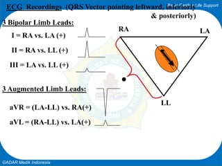 Basic Cardiac Life Support
GADAR Medik Indonesia
LARA
LL
ECG Recordings (QRS Vector pointing leftward, inferiorly
& posteriorly)
3 Bipolar Limb Leads:
I = RA vs. LA (+)
II = RA vs. LL (+)
III = LA vs. LL (+)
3 Augmented Limb Leads:
aVR = (LA-LL) vs. RA(+)
aVL = (RA-LL) vs. LA(+)
 
