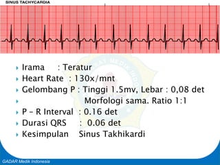 Basic Cardiac Life Support
GADAR Medik Indonesia
 Irama : Teratur
 Heart Rate : 130x/mnt
 Gelombang P : Tinggi 1.5mv, Lebar : 0,08 det
 Morfologi sama. Ratio 1:1
 P – R Interval : 0.16 det
 Durasi QRS : 0.06 det
 Kesimpulan Sinus Takhikardi
 
