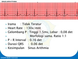 Basic Cardiac Life Support
GADAR Medik Indonesia
 Irama : Tidak Teratur
 Heart Rate : 130x/mnt
 Gelombang P : Tinggi 1.5mv, Lebar : 0,08 det
 Morfologi sama. Ratio 1:1
 P – R Interval : 0.16 det
 Durasi QRS : 0.06 det
 Kesimpulan Sinus Arithmia
 