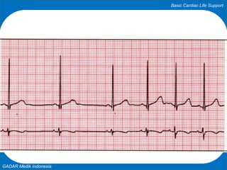Basic Cardiac Life Support
GADAR Medik Indonesia
 