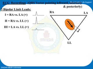 Basic Cardiac Life Support
GADAR Medik Indonesia
LARA
LL
ECG Recordings (QRS Vector pointing leftward, inferiorly
& posteriorly)
3 Bipolar Limb Leads:
I = RA vs. LA (+)
II = RA vs. LL (+)
III = LA vs. LL (+)
 