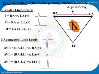 Basic Cardiac Life Support
GADAR Medik Indonesia
LARA
LL
ECG Recordings (QRS Vector pointing leftward, inferiorly
& posteriorly)
3 Bipolar Limb Leads:
I = RA vs. LA (+)
II = RA vs. LL (+)
III = LA vs. LL (+)
3 Augmented Limb Leads:
aVR = (LA-LL) vs. RA(+)
aVL = (RA-LL) vs. LA(+)
aVF = (RA-LA) vs. LL(+)
 