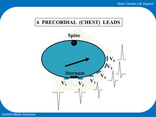 Basic Cardiac Life Support
GADAR Medik Indonesia
V1 V2
V3
V4
V5
V6
6 PRECORDIAL (CHEST) LEADS
Spine
Sternum
 