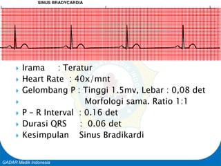 Basic Cardiac Life Support
GADAR Medik Indonesia
 Irama : Teratur
 Heart Rate : 40x/mnt
 Gelombang P : Tinggi 1.5mv, Lebar : 0,08 det
 Morfologi sama. Ratio 1:1
 P – R Interval : 0.16 det
 Durasi QRS : 0.06 det
 Kesimpulan Sinus Bradikardi
 